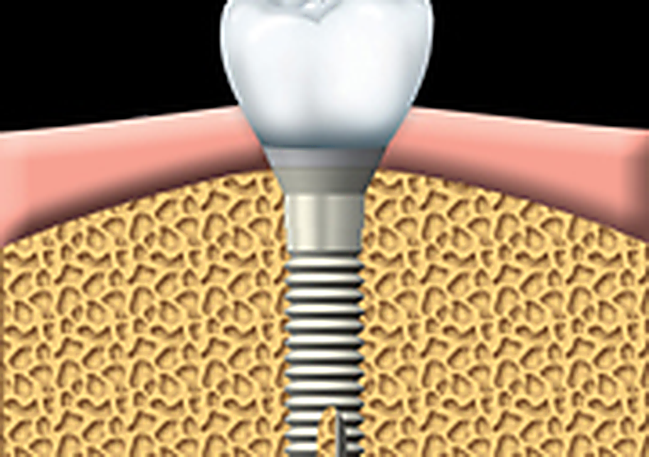 An artificial tooth is attached to the abutment. Properly fitting the artificial tooth may take several appointments.