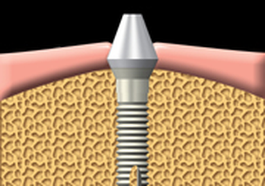 An abutment is attached to the implant. The abutment connects the artificial tooth to the implant.