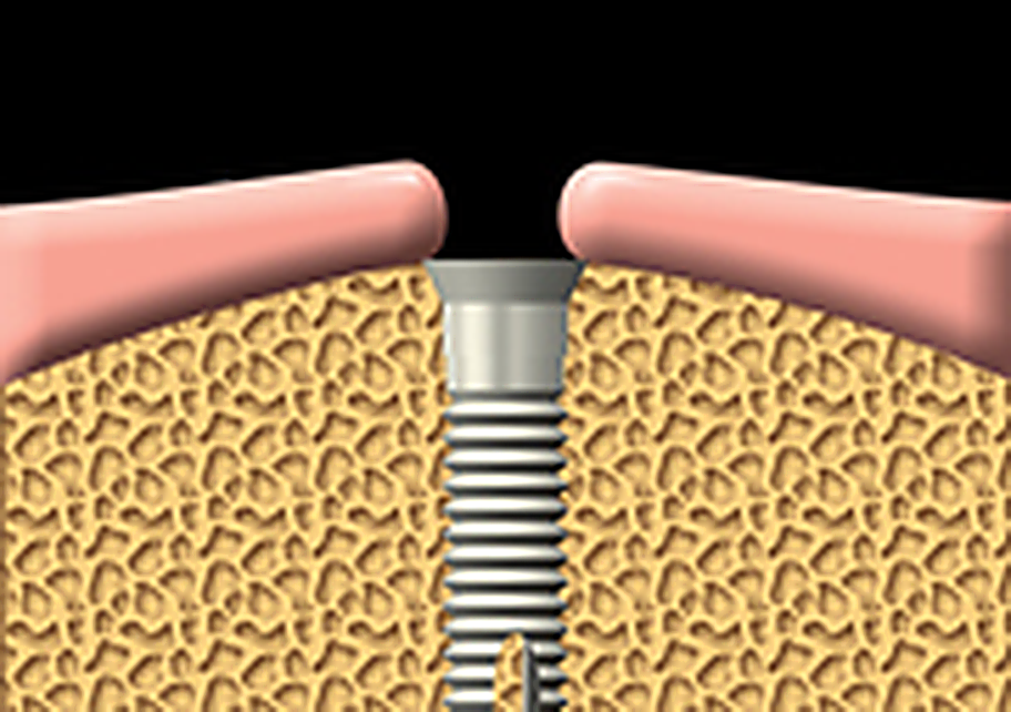 A dental implant is inserted into the jawbone.