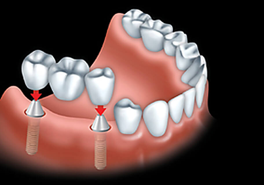A fixed bridge is anchored to dental implants to replace all teeth.