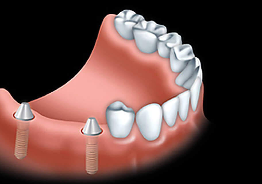 A fixed bridge is anchored to dental implants to replace one or more teeth.