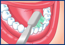 Toothbrush cleaning the inside surfaces of lower teeth and gums.