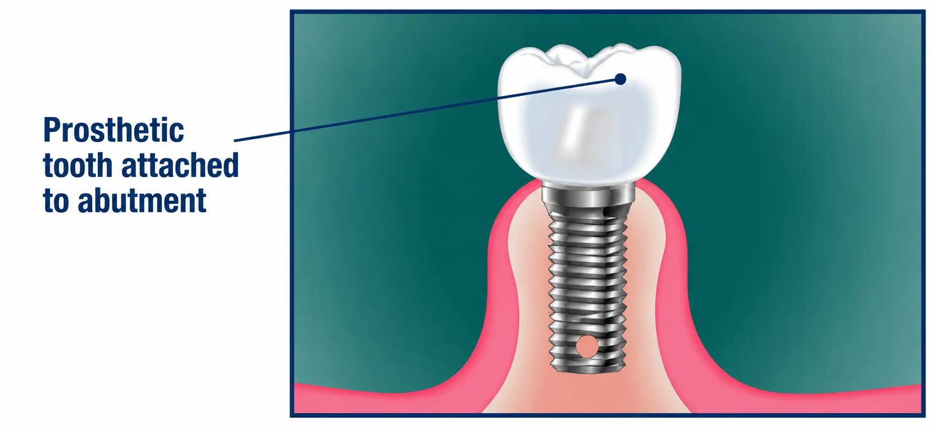 Dental implant diagram showing a prosthetic tooth attached to an abutment and implant post.