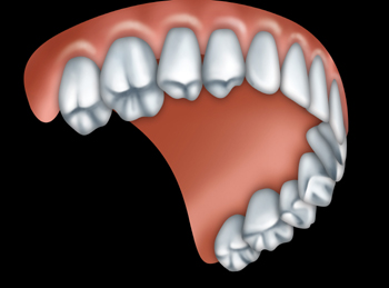 full denture