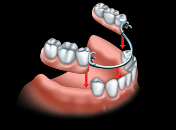 partial denture