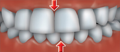 A crossbite occurs when one or more of your upper teeth don't line up with the appropriate lower tooth or teeth.
