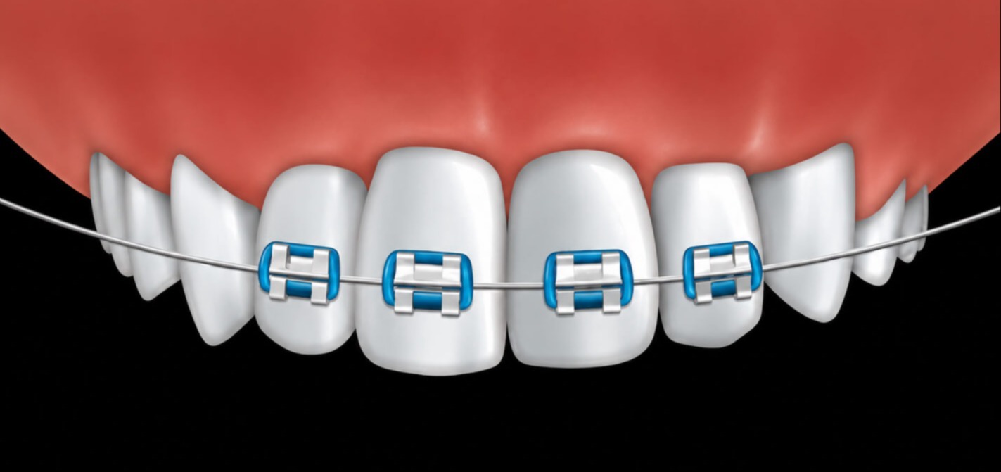 Close-up illustration of upper teeth with blue metal braces and orthodontic wire against a black background.