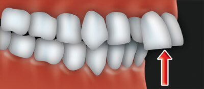 An overjet occurs when the upper front teeth protrude.
