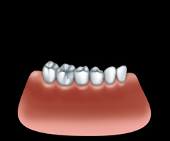 damaged teeth