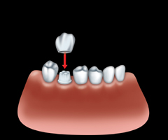 placing crown