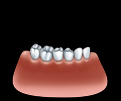 crown fixed