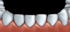 The finished tooth looks natural and smooth.