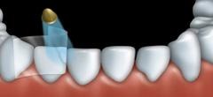 Each layer of the composite resin is shaped and then hardened with a light.