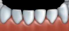 Dental bonding can be used to fix teeth that are chipped.